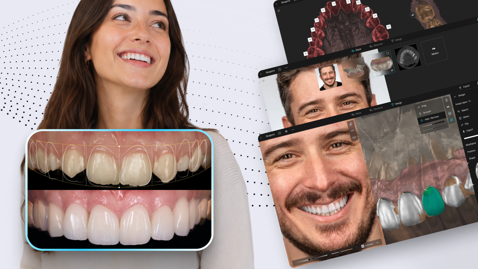 ¿Qué es el diseño de sonrisa?